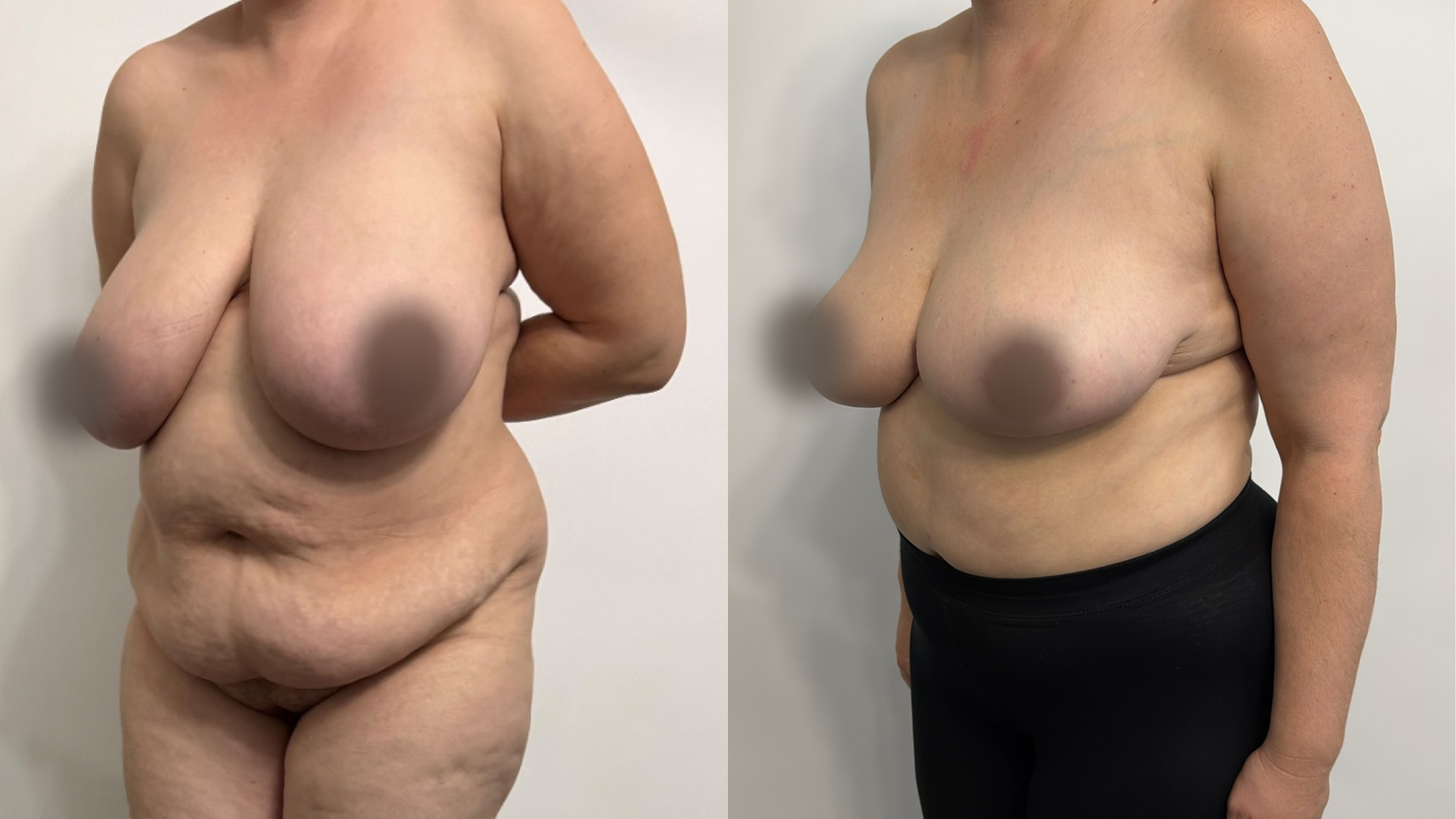 Bilat breast reduction. Cosm: abdominoplasty and Liposuction