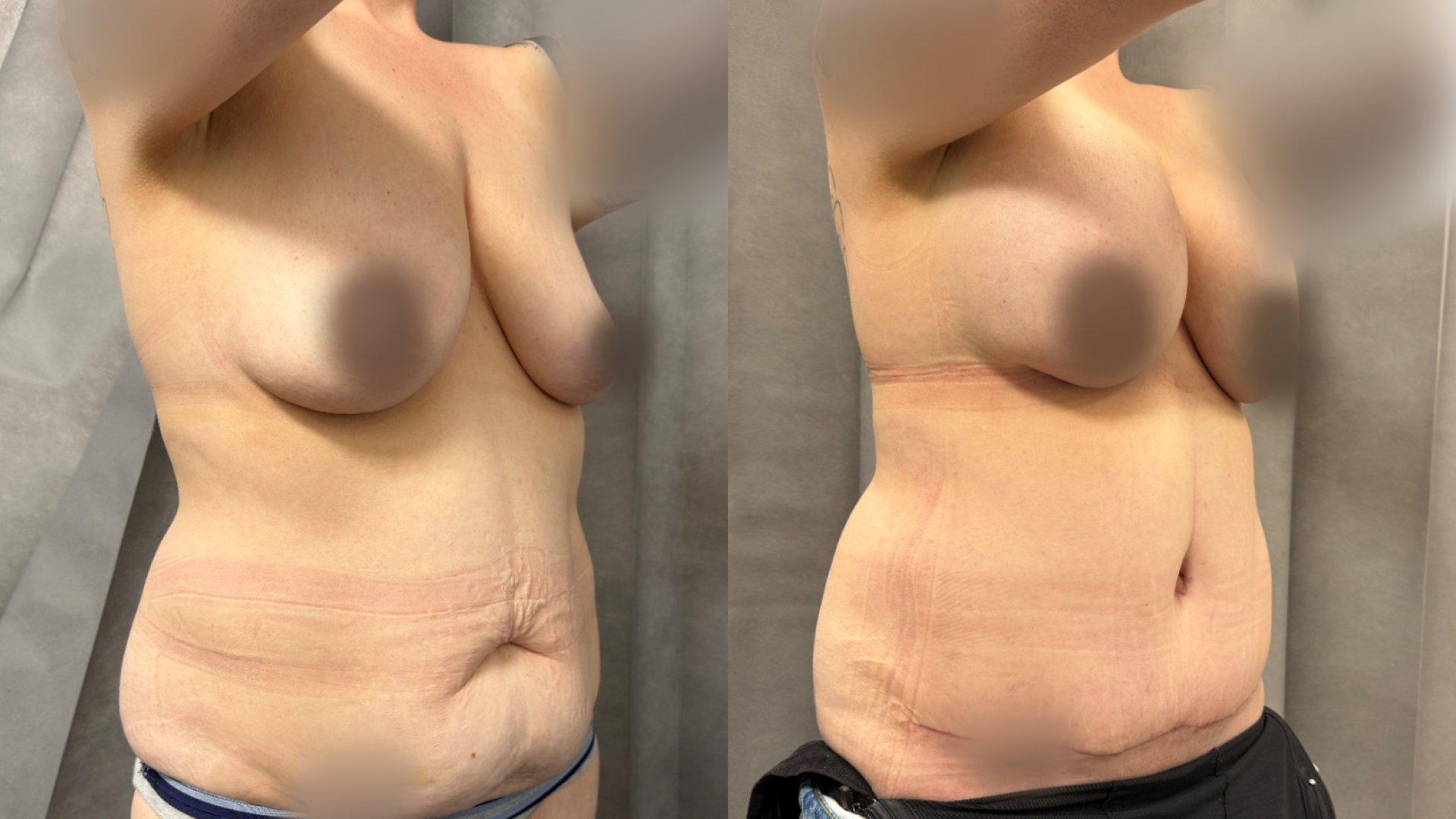 Abdominoplasty, BAM, Lipo