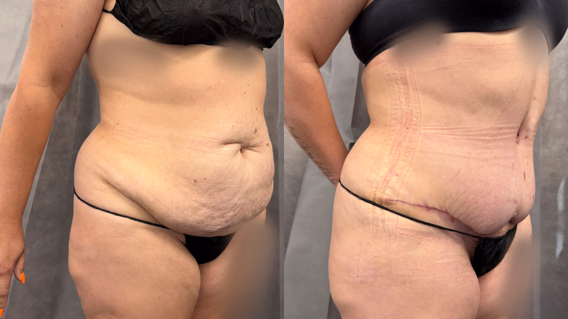 abdominoplasty and liposuction