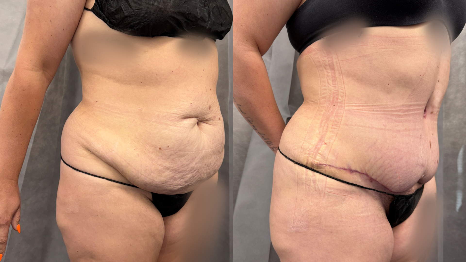 abdominoplasty and liposuction