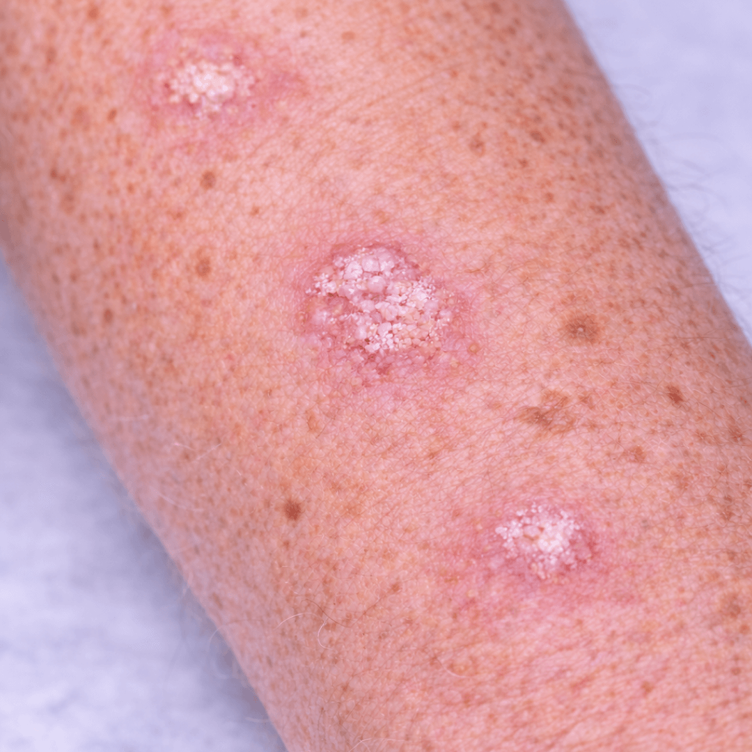 Actinic Keratosis