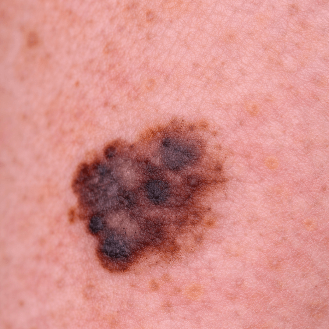Melanoma