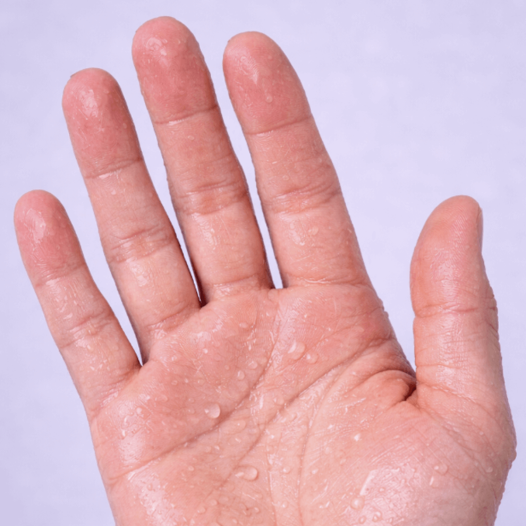 Hyperhidrosis