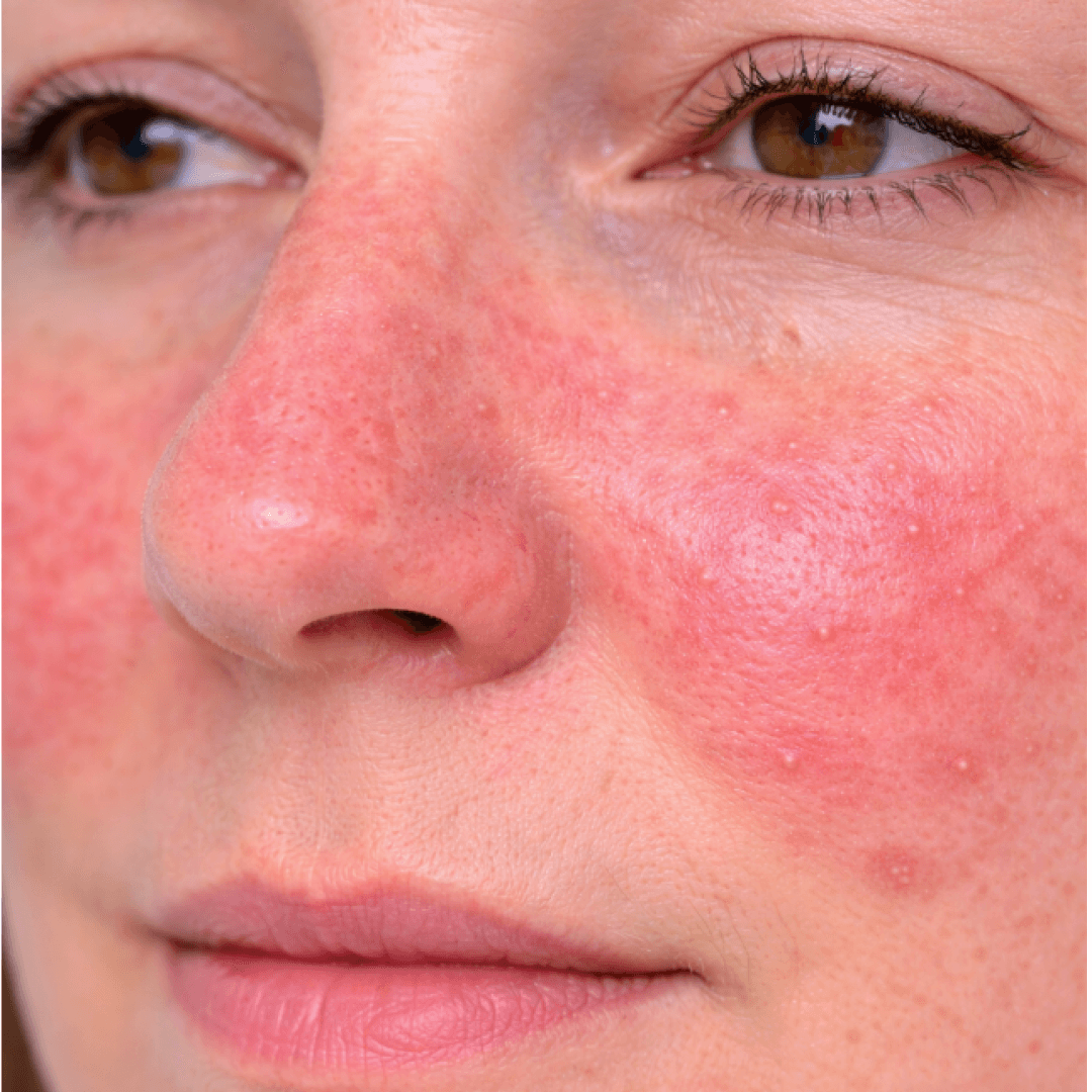Rosacea