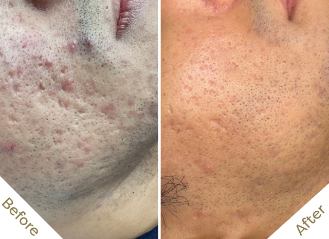 acne-scar-microneedling-before-after-southsea.