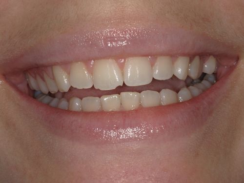 before and after treatment