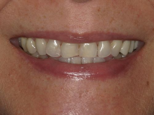 before and after treatment