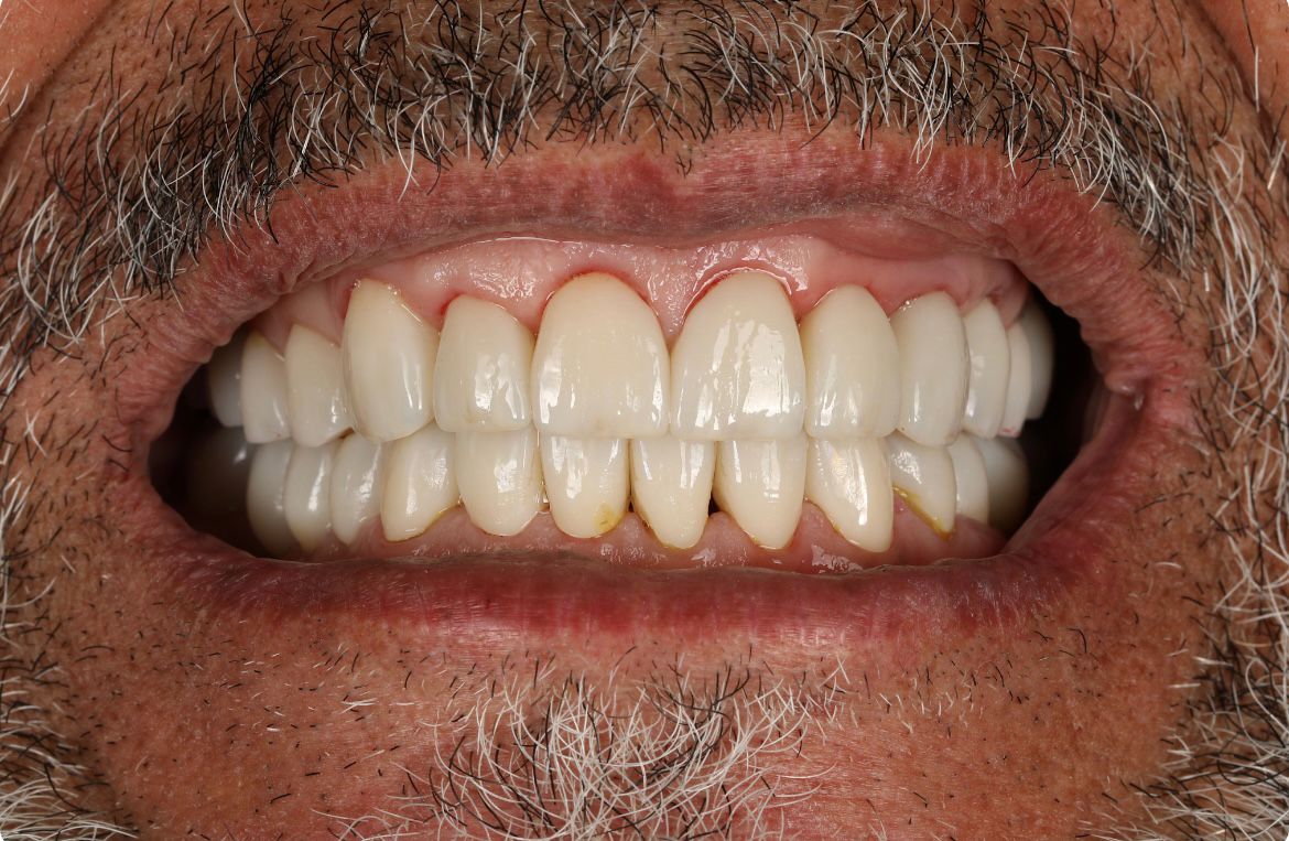 Smile Makeover after treatment at Flawless Dental Studio
