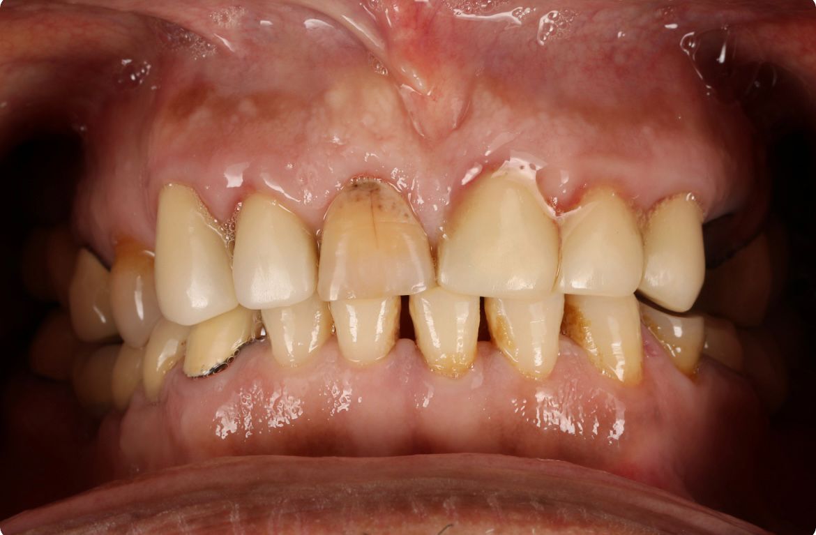 Another smile. Another story. — same patient before treatment