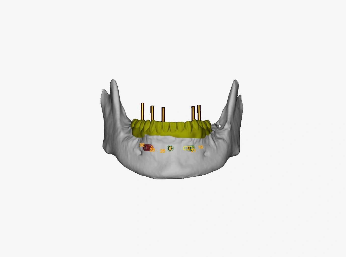 3D lower-jaw planning model showing proposed teeth and virtual implant positions.
