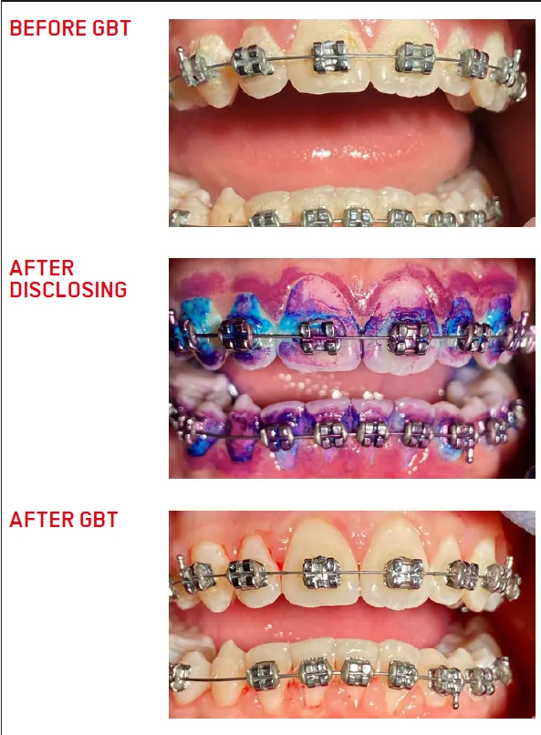 GBT with braces: clinical case 2