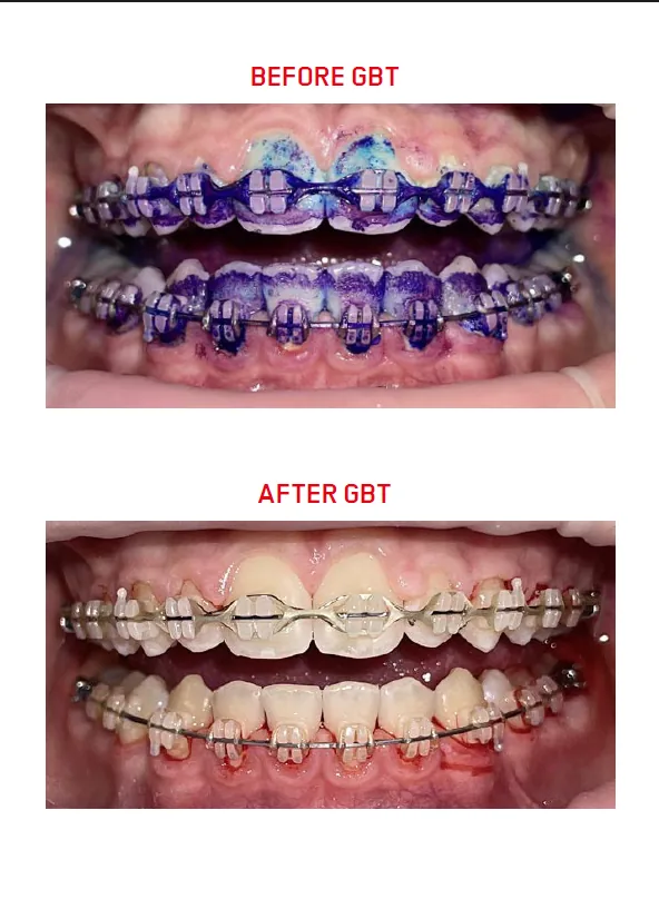 GBT with braces: clinical case 3