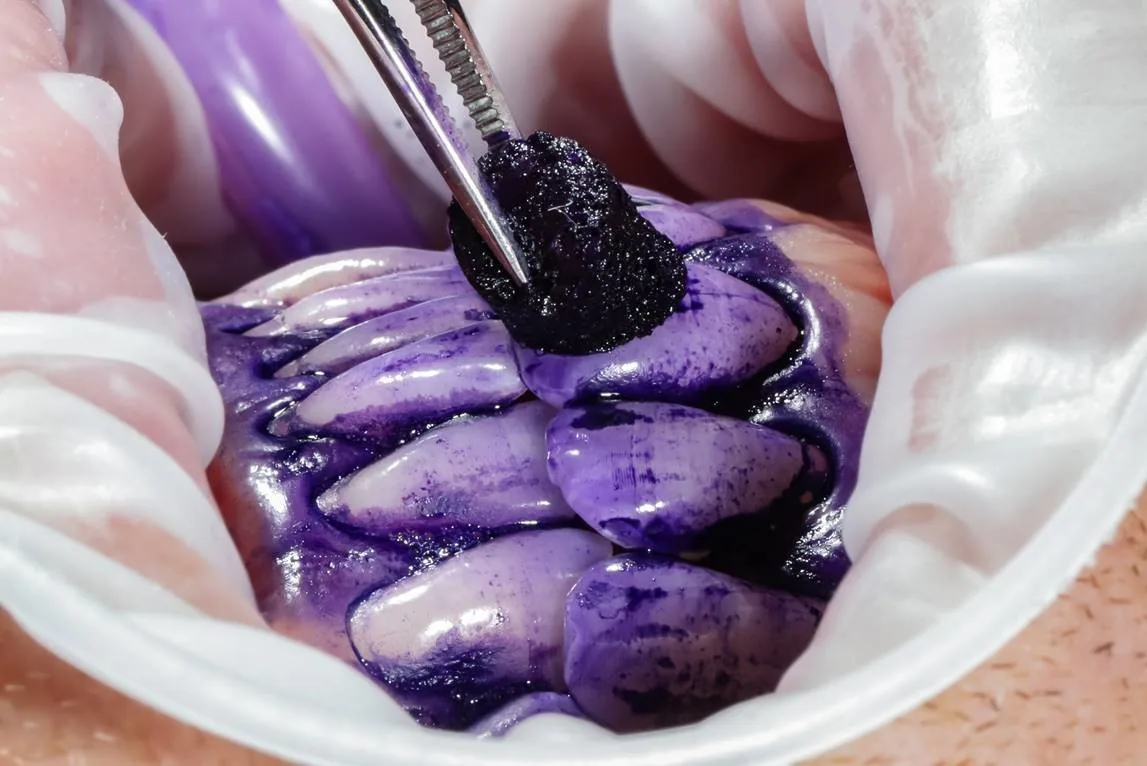 Purple biofilm-disclosing dye showing plaque around the teeth and gumlines