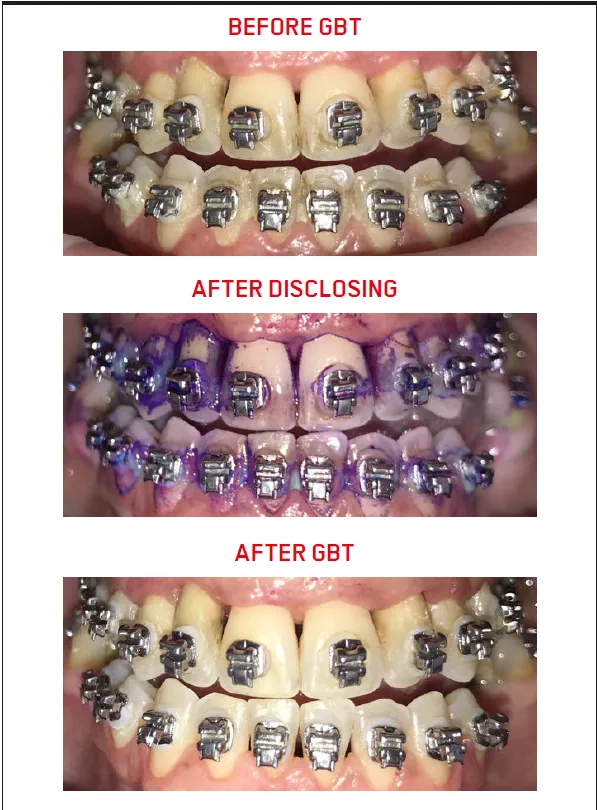 GBT with braces: clinical case 1