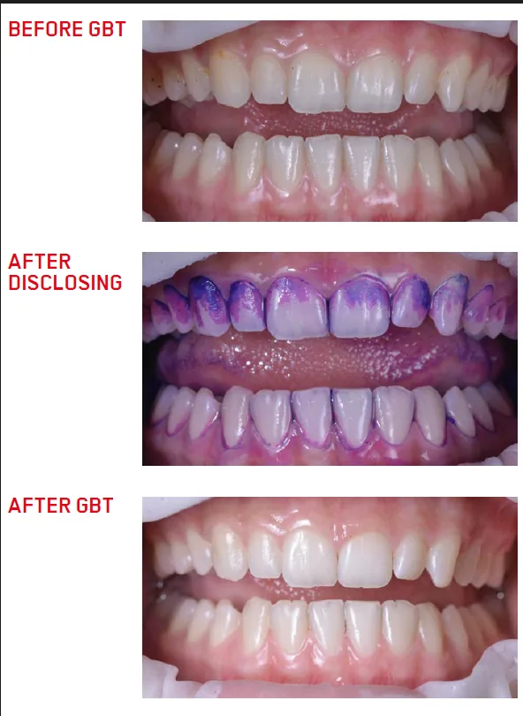 Biofilm disclosure and GBT: clinical case 2