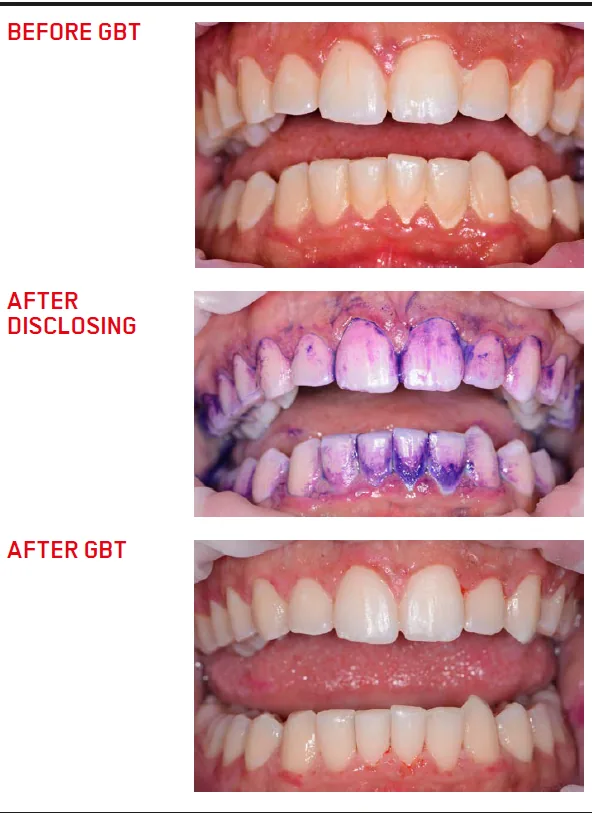 Biofilm disclosure and GBT: clinical case 4