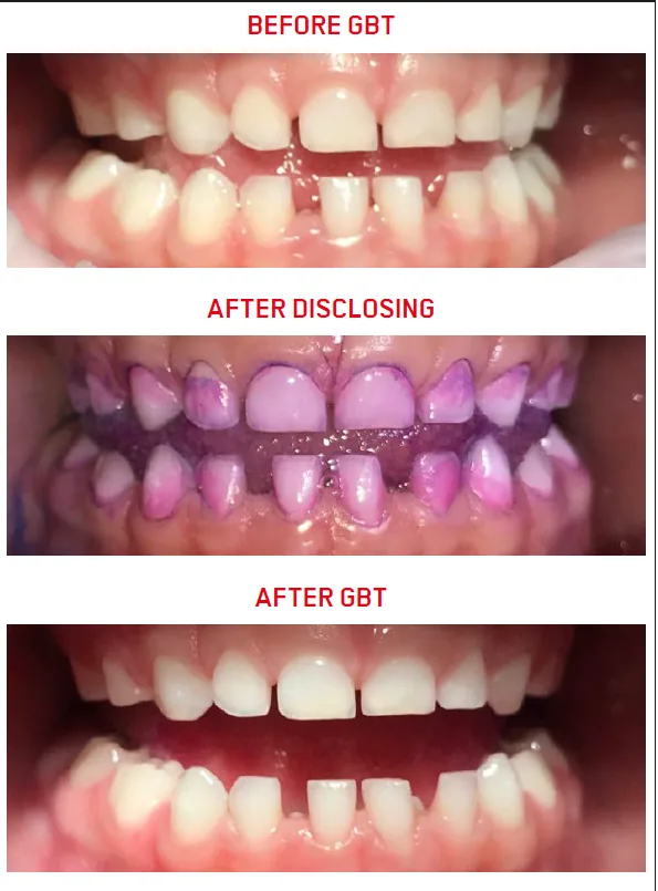 Biofilm disclosure and GBT: clinical case 6