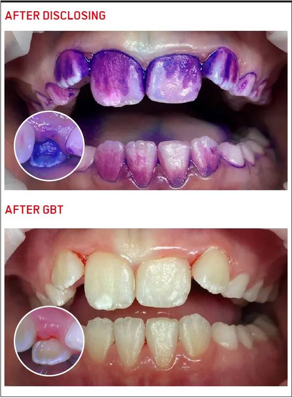 Biofilm disclosure and GBT: clinical case 5