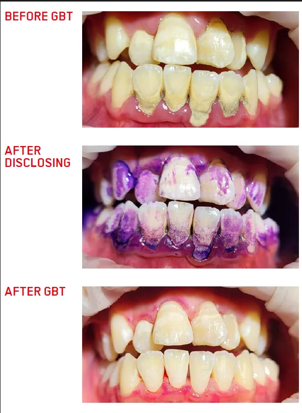 Biofilm disclosure and GBT: clinical case 3