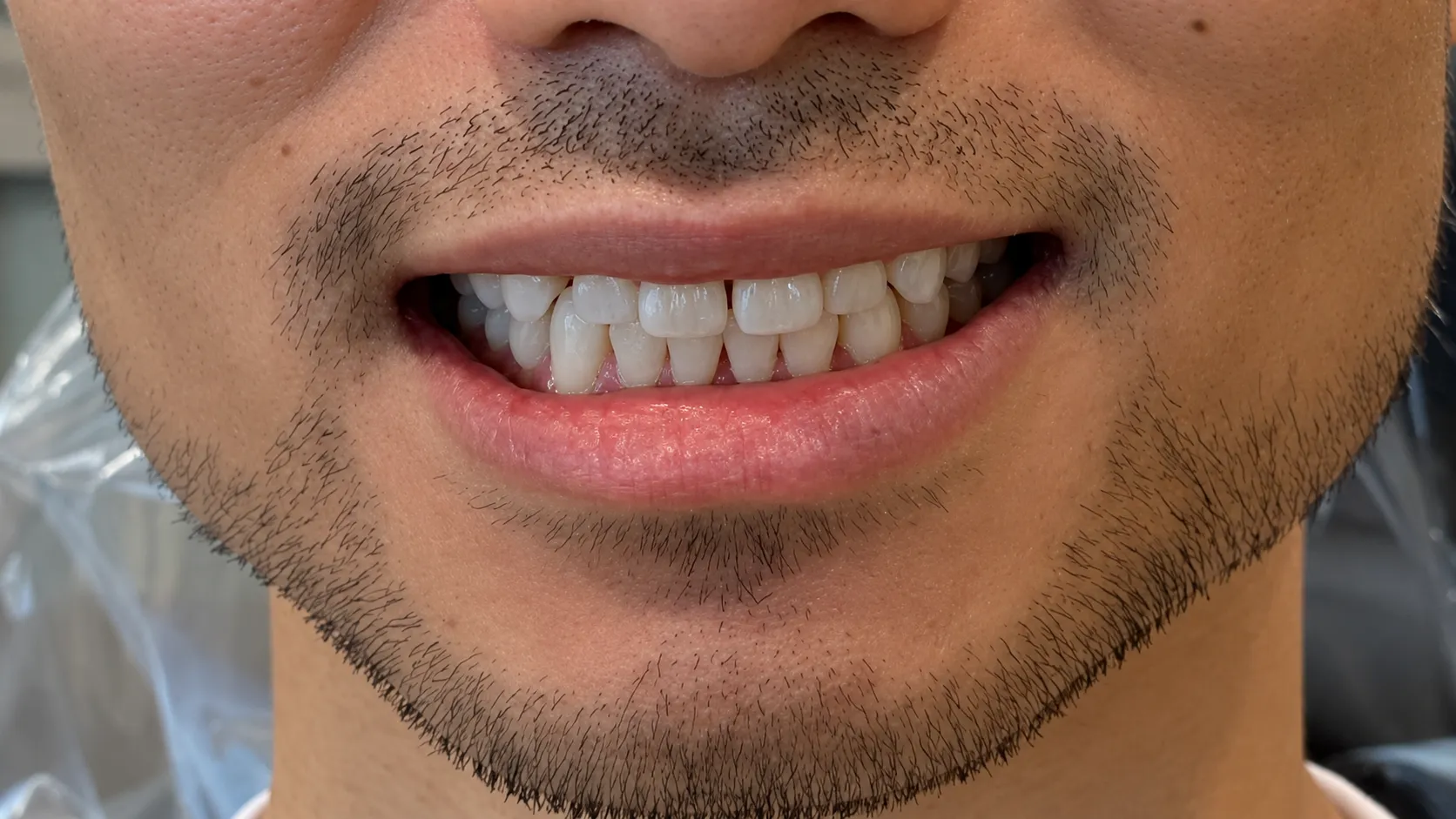 Patient smile before Invisalign treatment at Flawless Dental Studio.