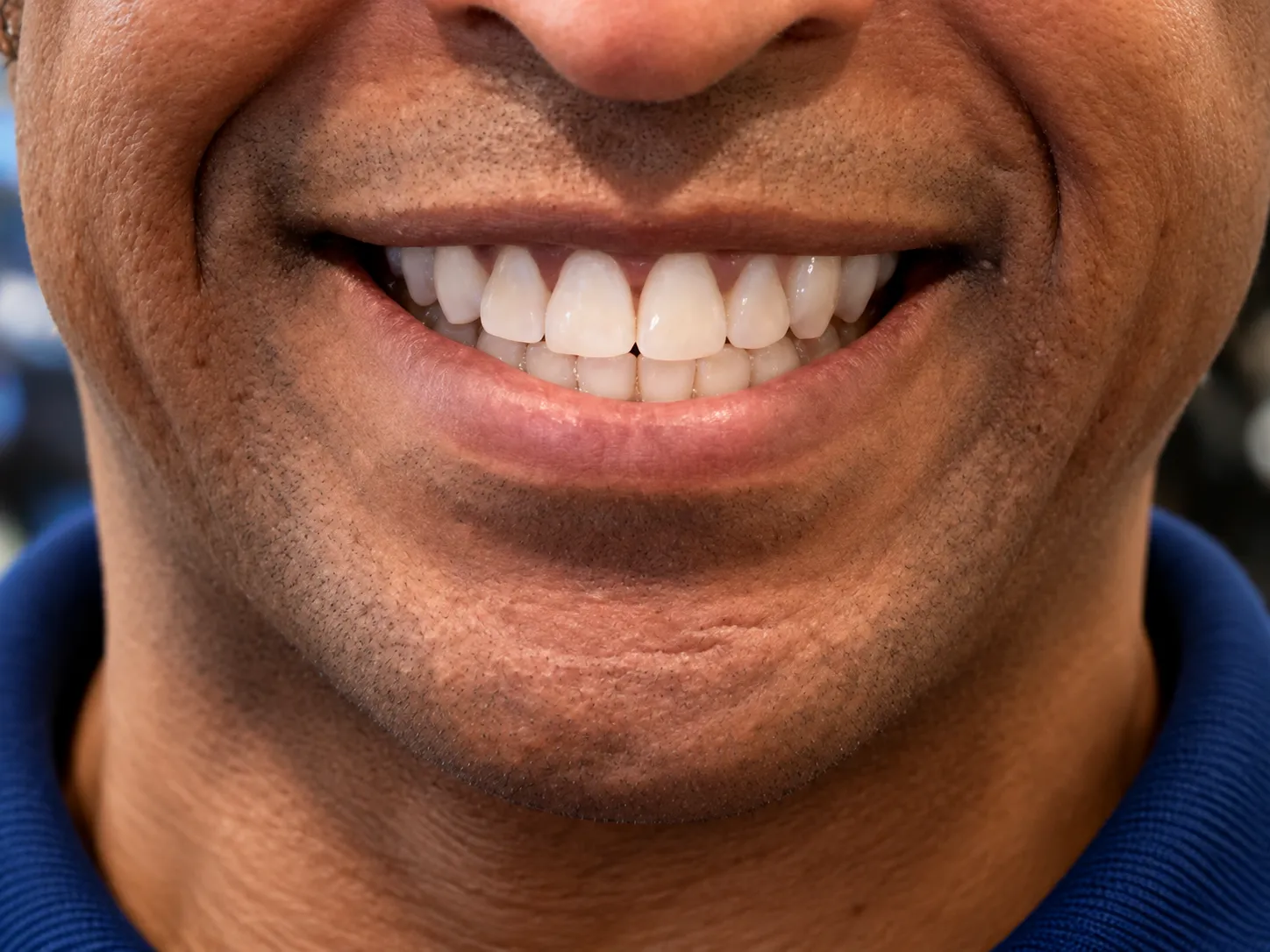 Second patient smile after Invisalign treatment at Flawless Dental Studio.
