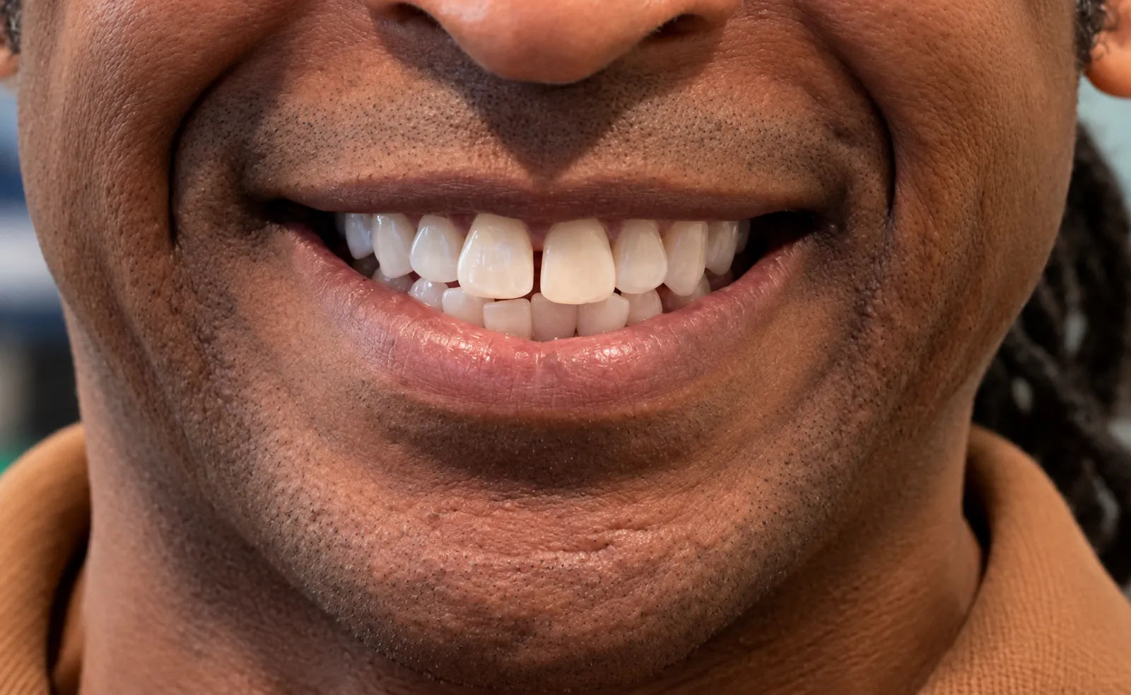 Second patient smile before Invisalign treatment at Flawless Dental Studio.