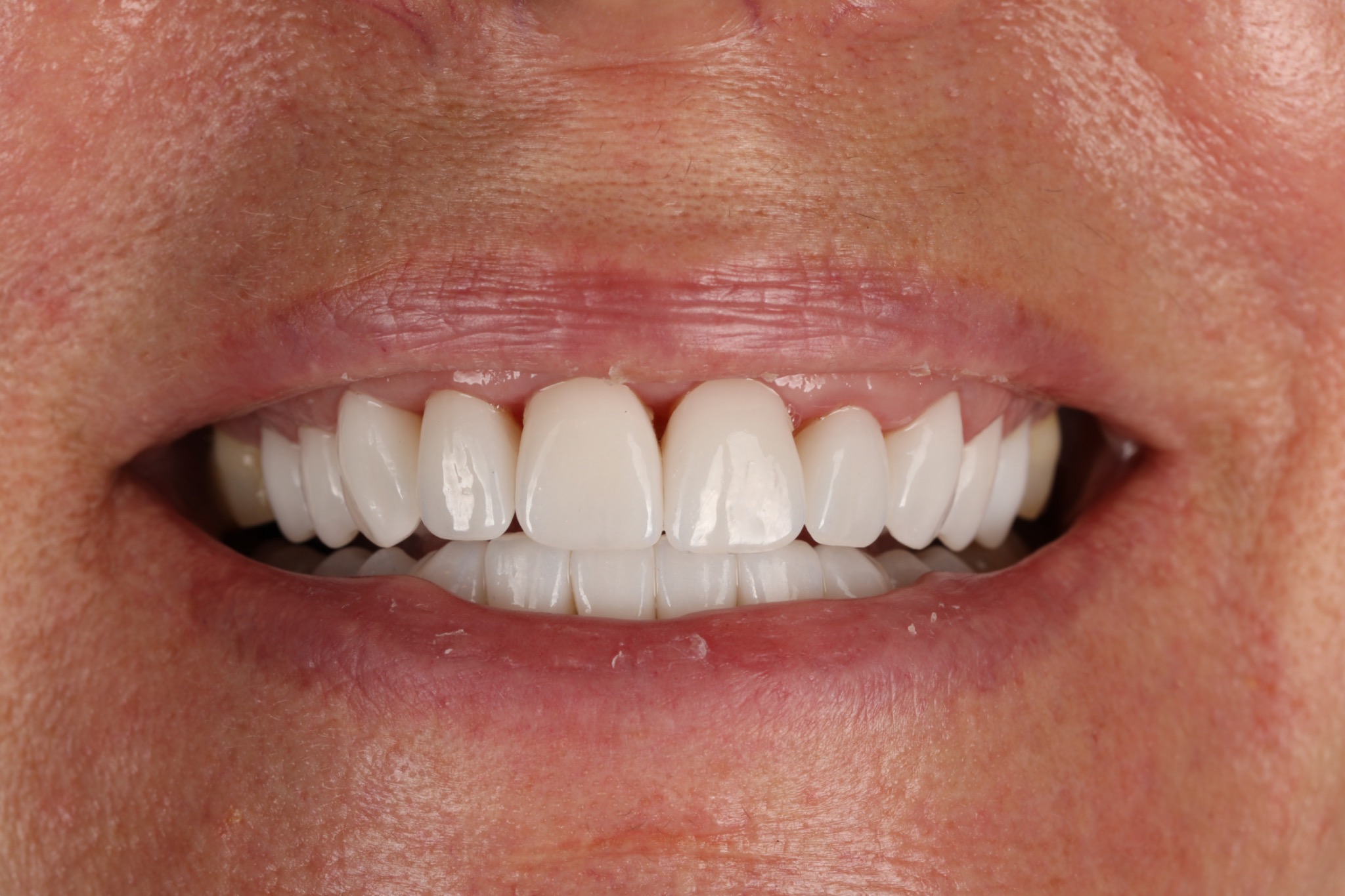 After the smile restoration for the patient with worn, fractured veneers