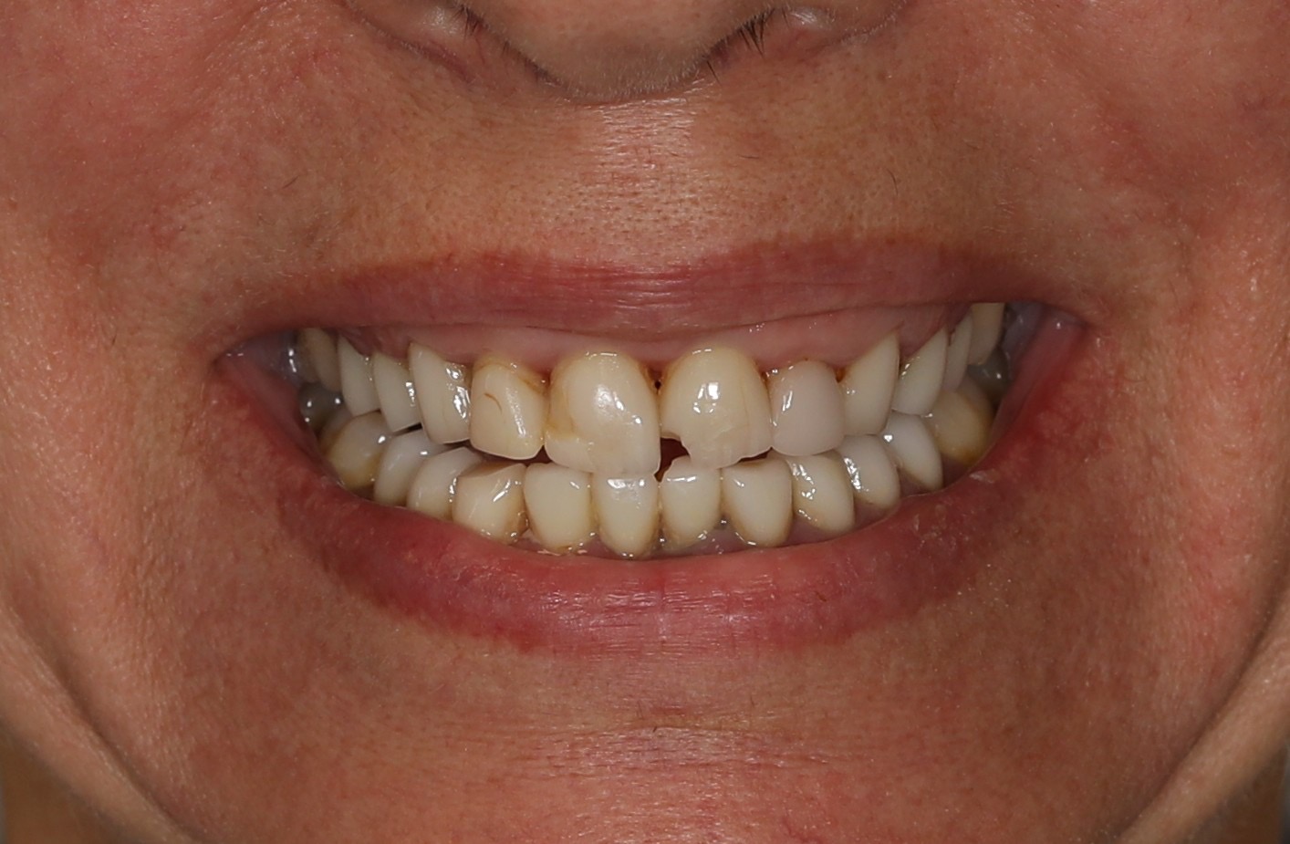 Before treatment: 20-year-old veneers with fractures and wear