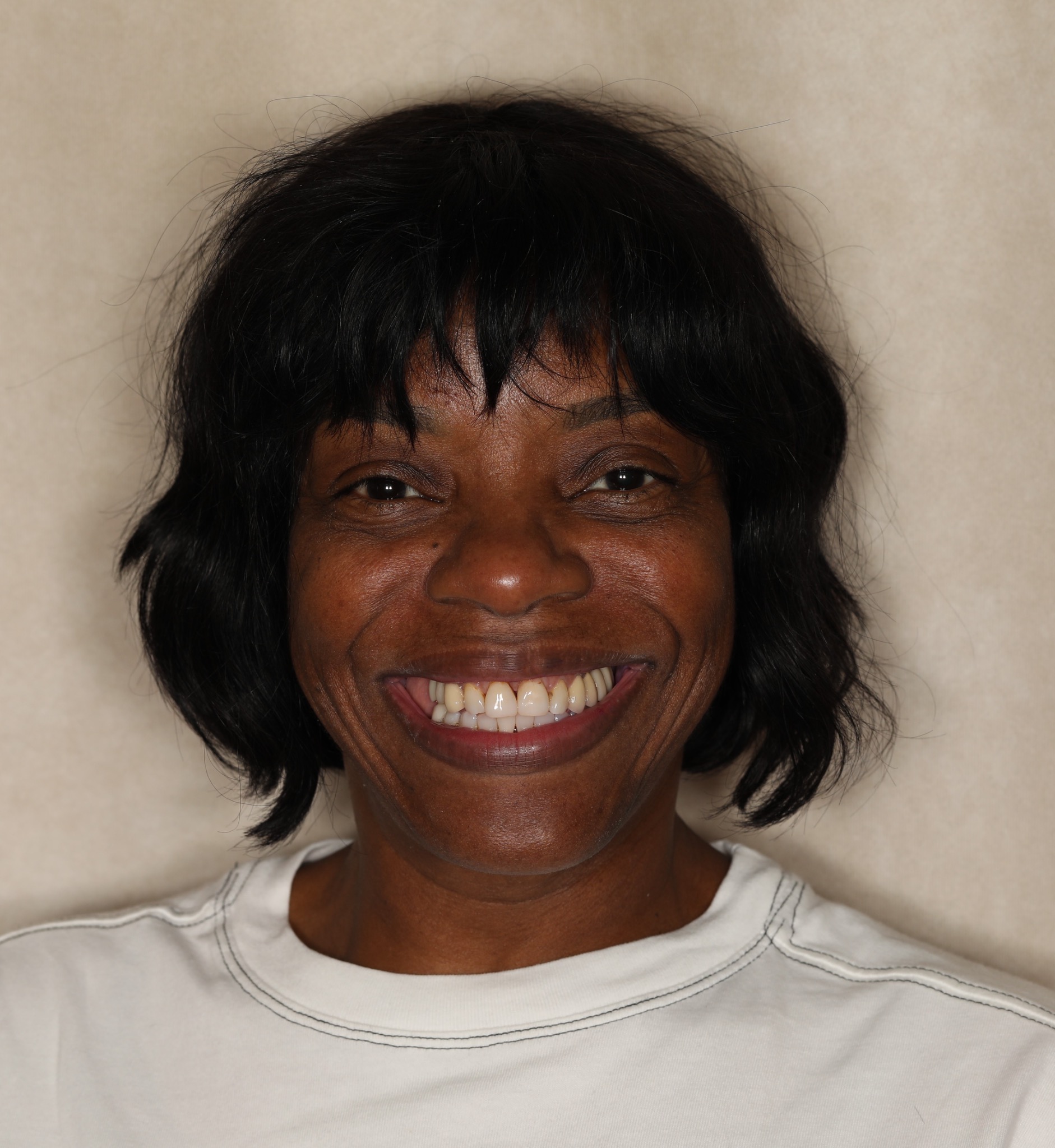Before the smile refinement — patient smiling in a portrait