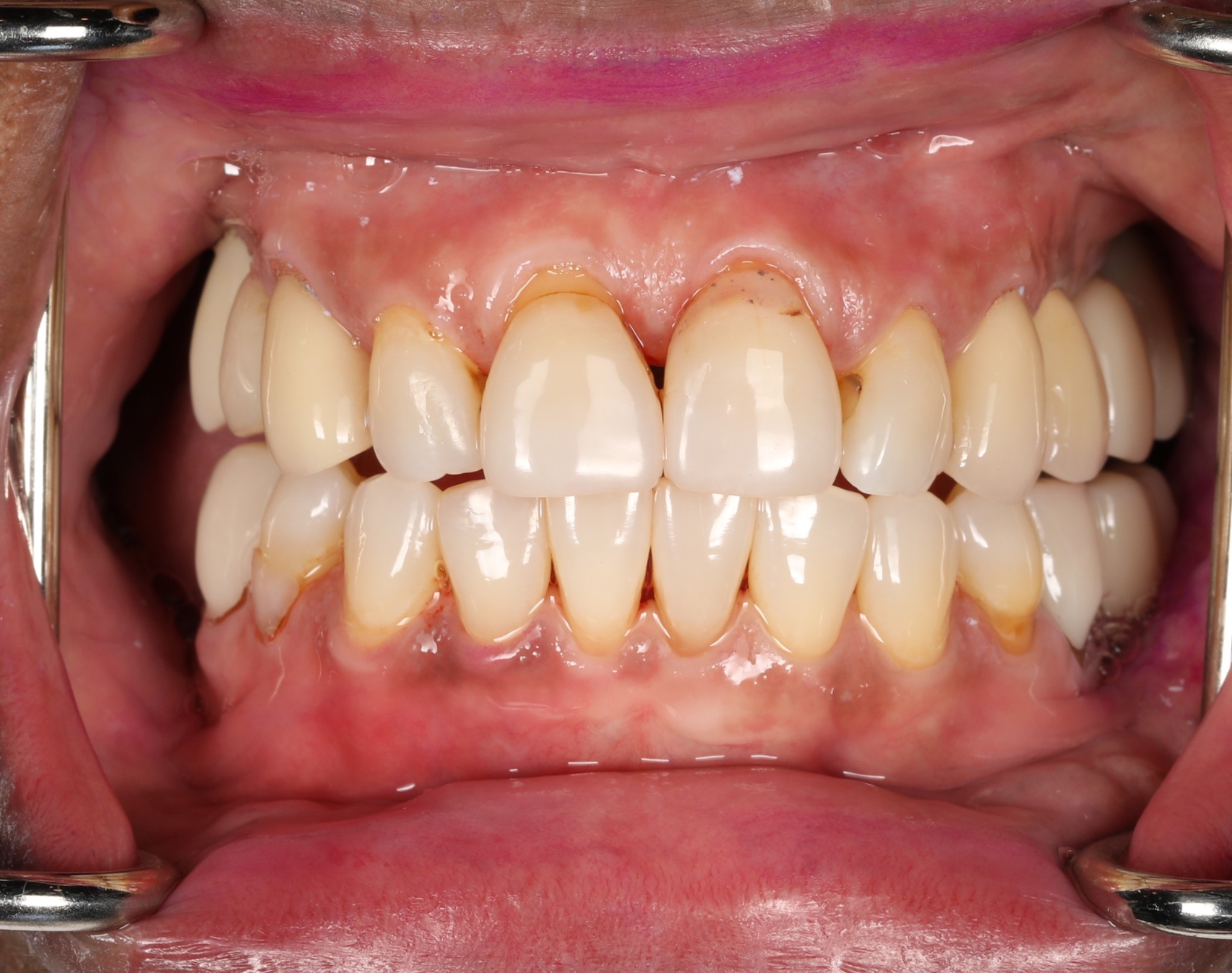 Before smile refinement — close-up of the original smile