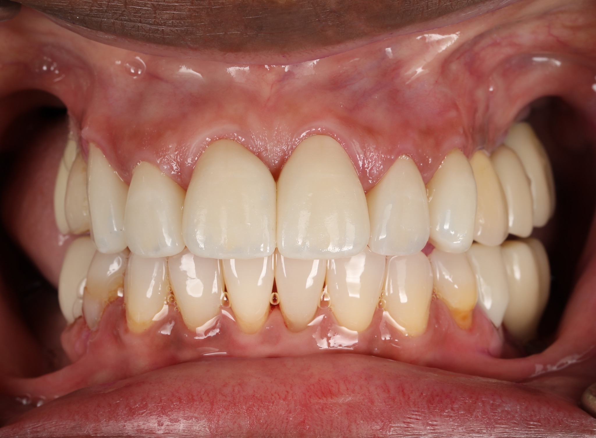 After smile refinement — close-up of the completed smile