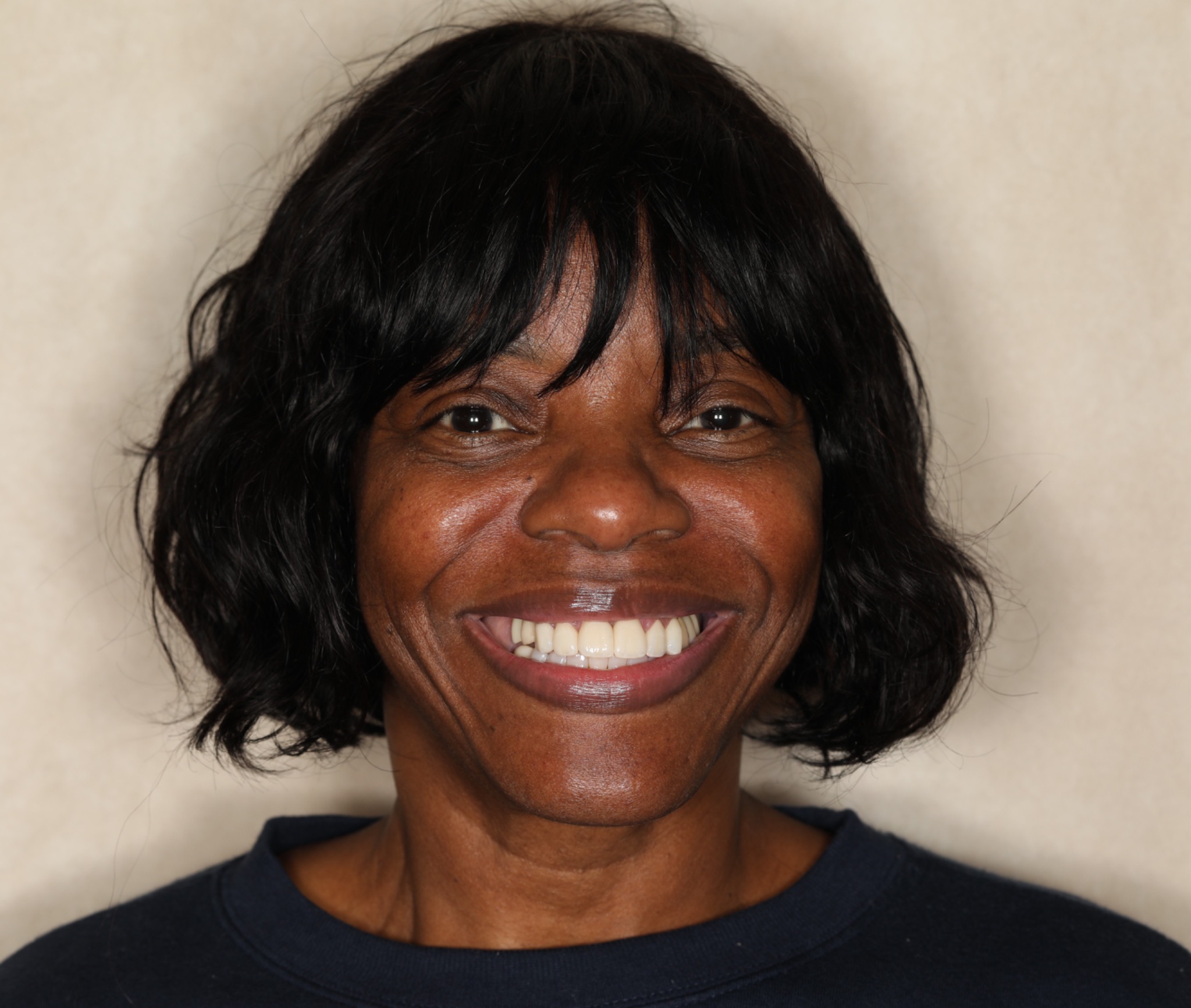 After the smile refinement — the patient’s completed smile in a portrait