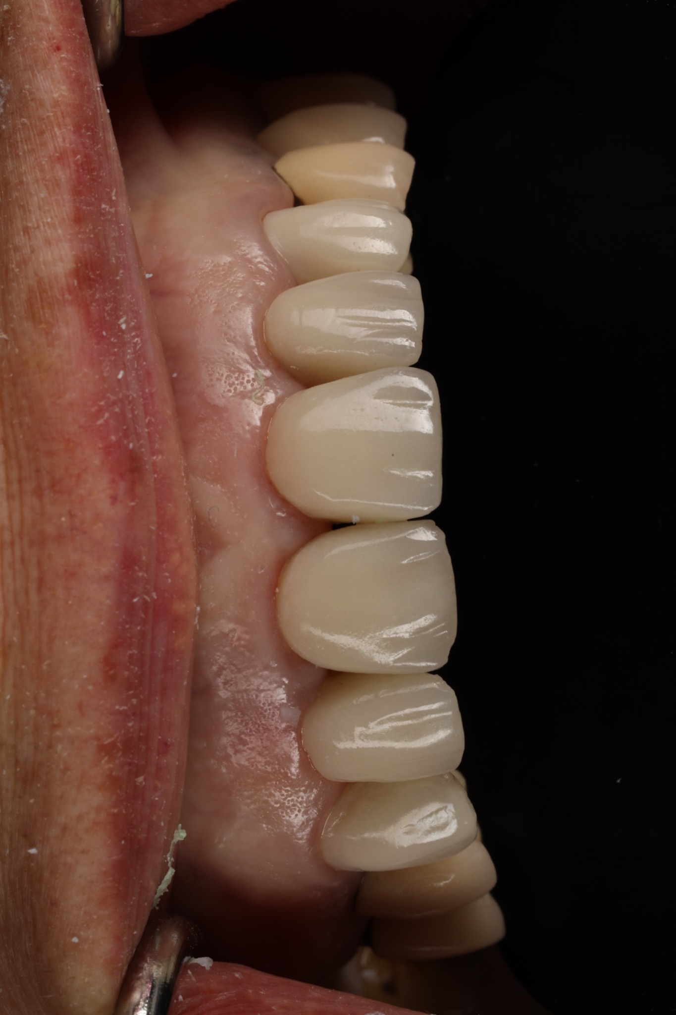 Before replacement — close-up of the original upper veneers