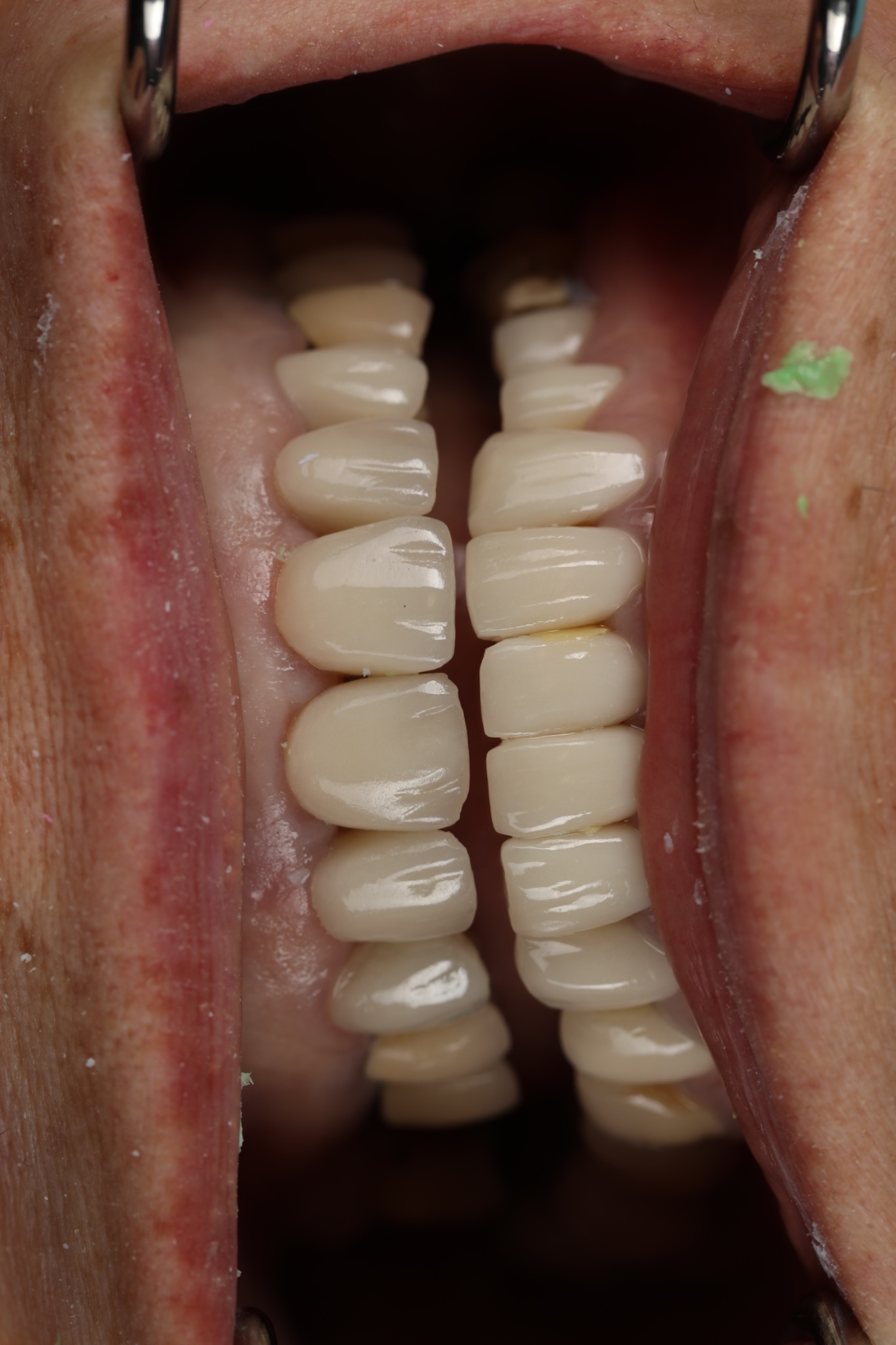 Before replacement — upper and lower veneers in the clinical bite photograph
