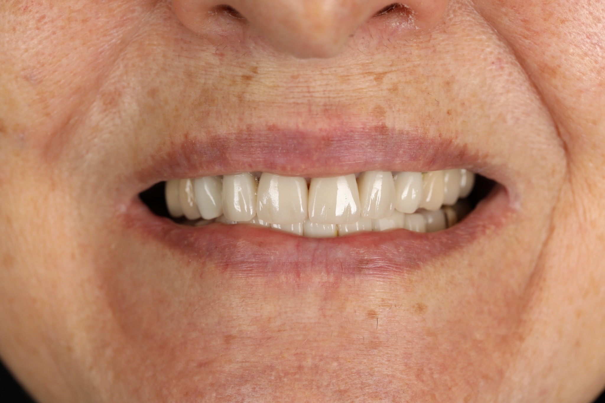 Before treatment — 15-year-old discolored veneers in the smile