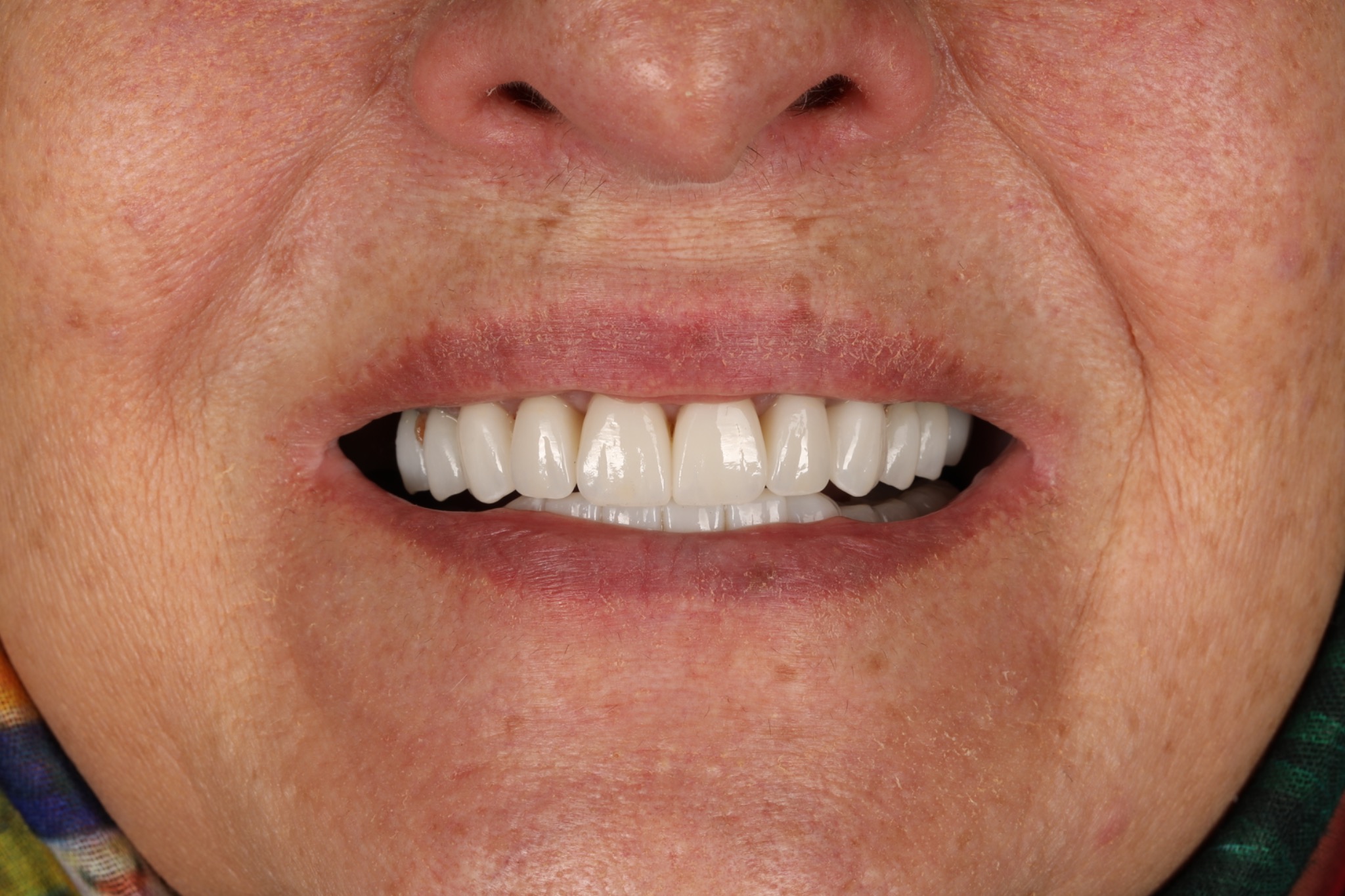 After replacement of 10 upper and 10 lower veneers — smile view