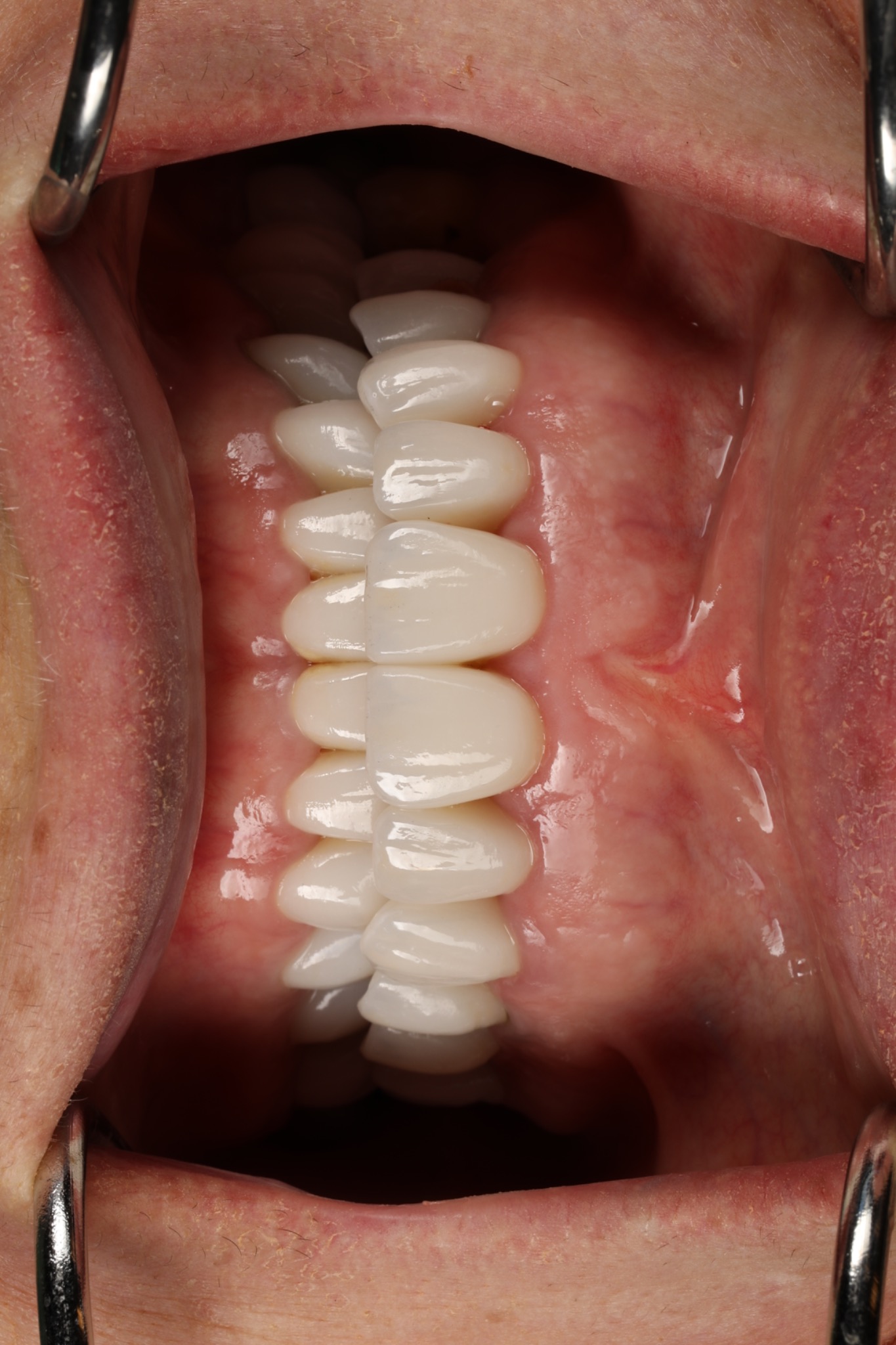 After replacement — upper and lower veneers in the clinical bite photograph