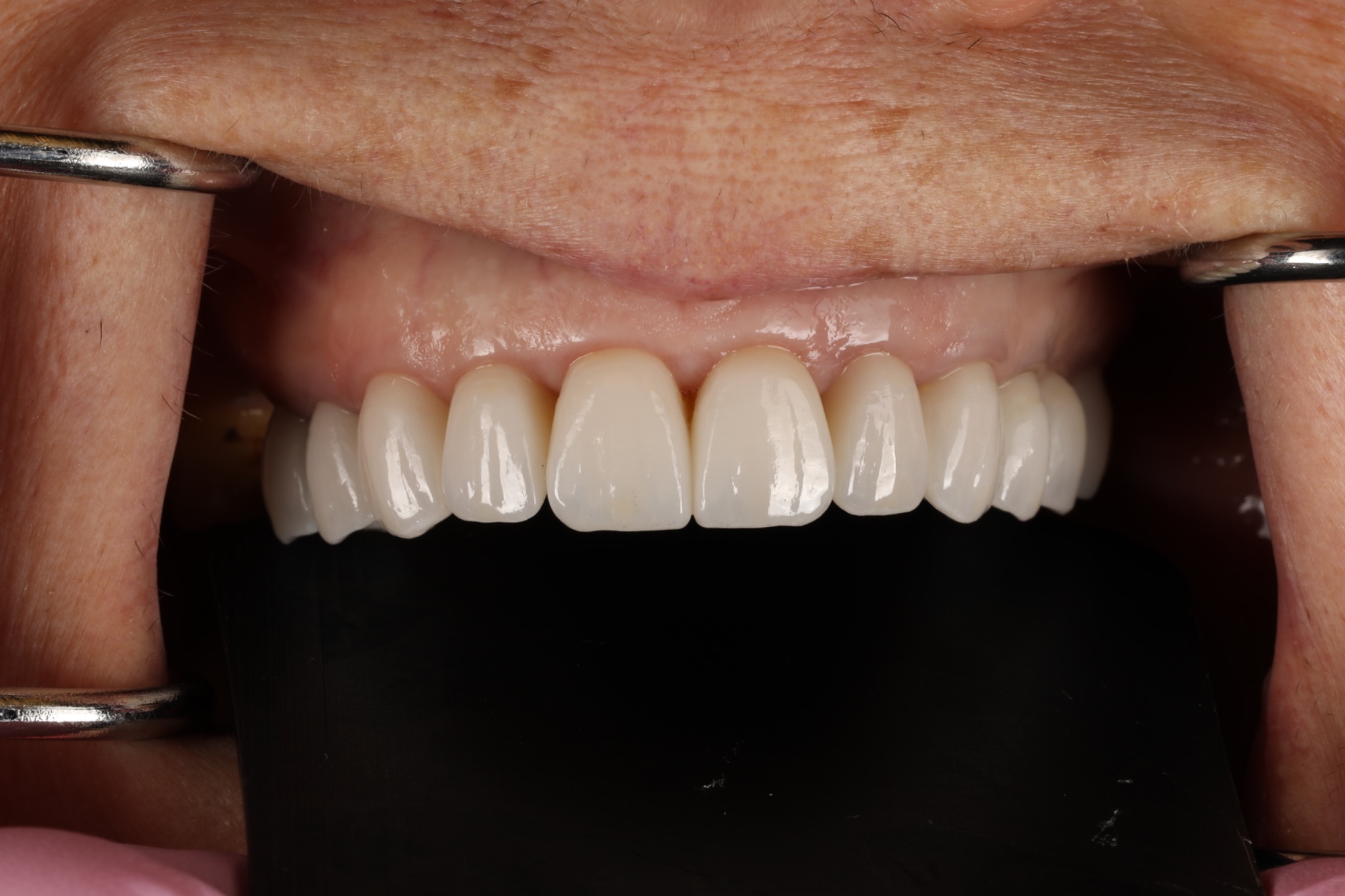 After replacement — close-up of the new upper veneers