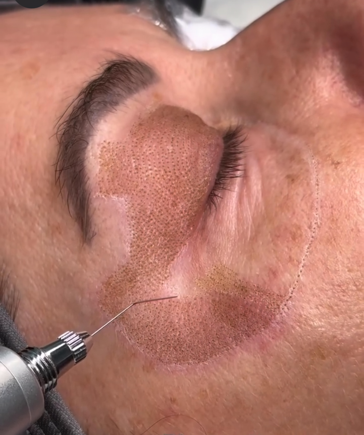 Why Some Plasma Results Heal Beautifully - While Others Lead to Pigmentation and Scarring