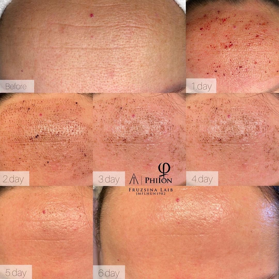 Healing Process Explained: What to Expect After a Plasma Fibroblast Treatment