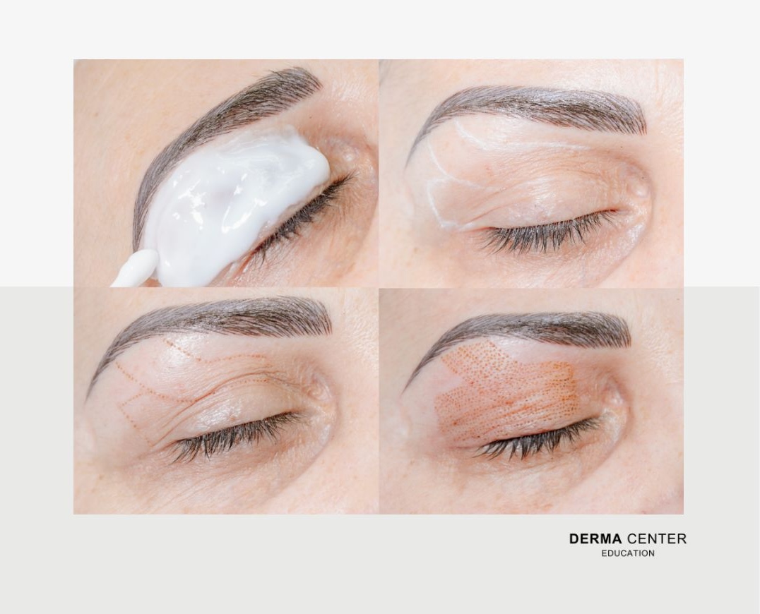 What Treatments Can You Perform After Plasma Fibroblast Training? A Clinical Overview