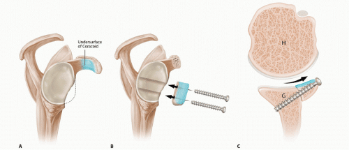 Latarjet stabilisatie van de schouder | Orthopedie & Traumatologie Mortsel