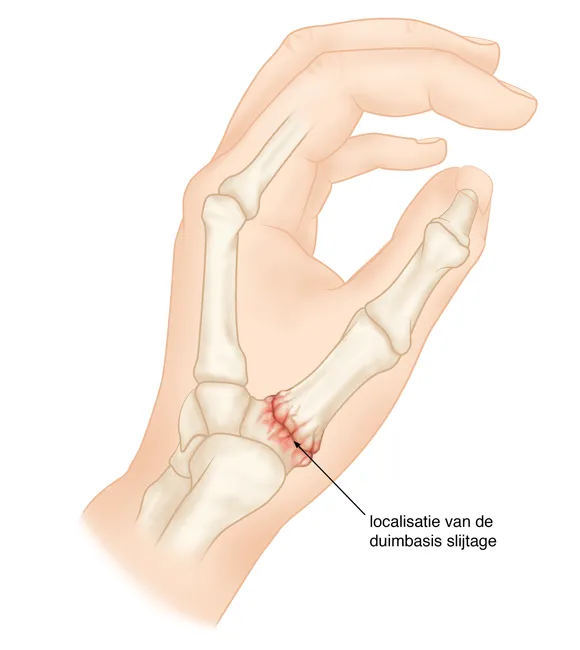 Illustratie van een hand met duimbasisartrose