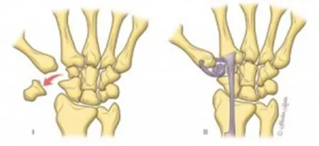 Trapeziumresectie LRTI-Duimartrose