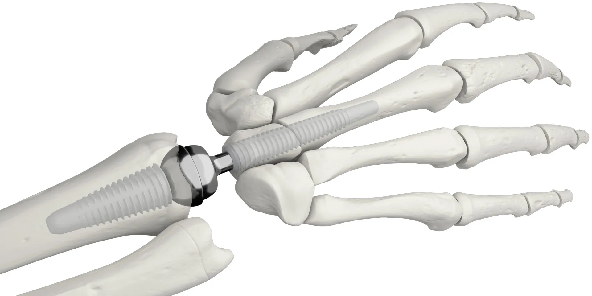 Polsprothese Motec kunstpols