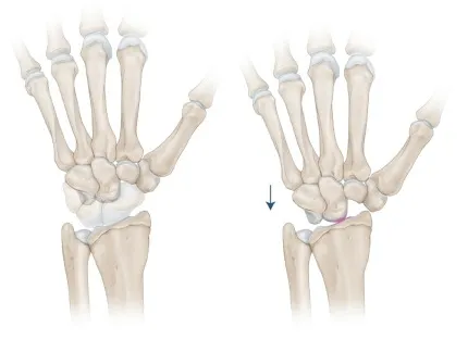 Proximale rijresectie