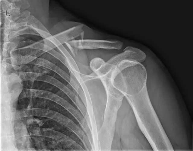 Gebroken sleutelbeen: medisch beeld bij Orthopedie Turnhout.