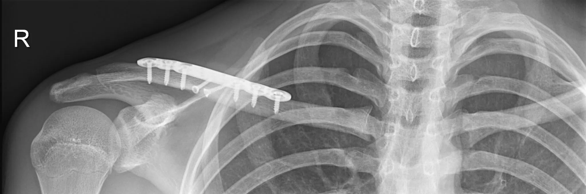 Gebroken sleutelbeen: fixatie met plaat op rontgenbeeld - Orthopedie Turnhout.