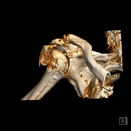 Schouderbreuk: medisch beeld bij Orthopedie Turnhout.