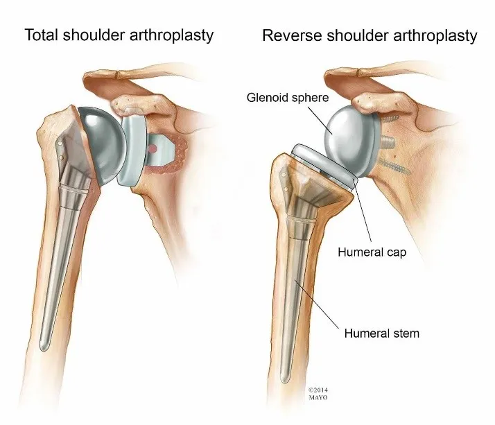 Schouderbreuk: prothese op rontgenbeeld - Orthopedie Turnhout.